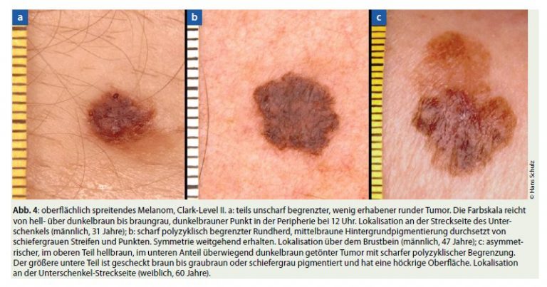 Welcher Hautkrebs Ist Gefährlicher Weiß Oder Schwarz hautarzt-schulz.de